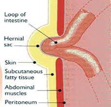 Disease, hernia (hernia) What